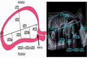 Uterine segmentation and volume measurement in uterine fibroid patients' MRI using fuzzy C-mean algorithm and morphological operations